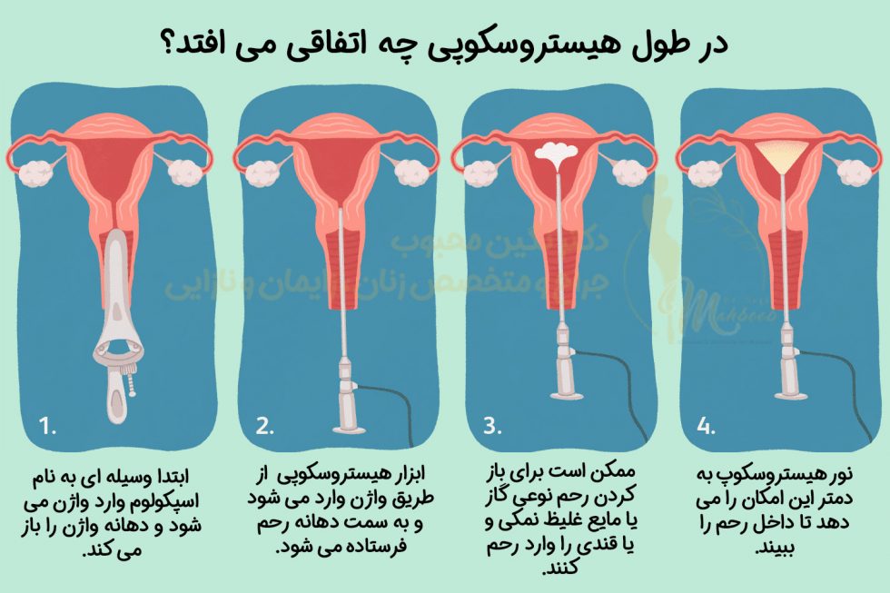 همه چیز درباره هیستروسکوپی بهترین متخصص زنان برای هیستروسکوپی دکتر